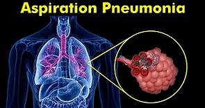 Breathing Trouble: Understanding Aspiration Pneumonia