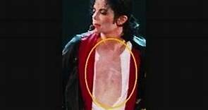 Michael Jackson ~ Vitiligo