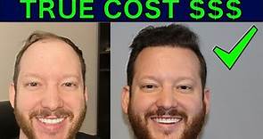 How Much Does A Hair Transplant Cost! True cost of hair transplant