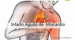 infarto de miocardio- Fisiopatología
