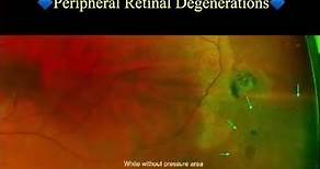 Peripheral Retinal Degenerations.
