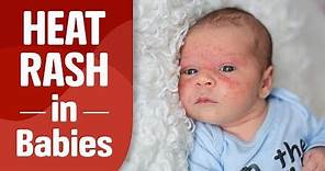 Heat Rash in Babies