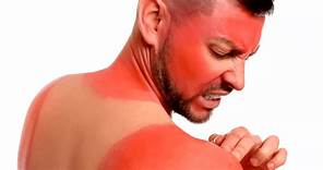 ¿Te insolaste la piel? Estos 5 remedios caseros ayudan a refrescar las quemaduras de sol