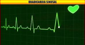 Bradicardia Sinusal
