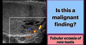 Tubular Ectasia of the Rete Testis #Radiology #Urology #Ultrasound