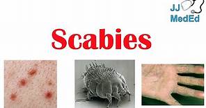Scabies (Skin Condition) | What Is It, Classic vs. Crusted Types, Signs & Symptoms, Treatment