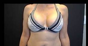 Breast Augmentation Results in a Bikini, 400cc Smooth Round Silicone High Profile Implants
