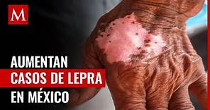 Aumentan los contagios de Lepra en México