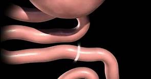 Roux en Y gastric bypass animation