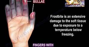 Frostbite - Everything You Need To Know - Dr. Nabil Ebraheim