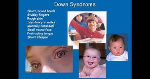 Chromosomal disorders