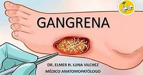 NO TE IMAGINAS 😲 ... ¿Qué es la GANGRENA🦶y sus TIPOS? - Dr. Elmer Luna Vilchez