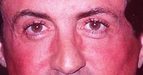 Has Sylvester Stallone Had Plastic Surgery?