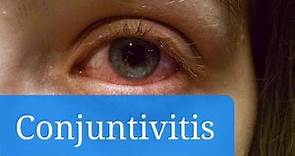Conjuntivitis vírica, alérgica y bacteriana: síntomas y tratamiento