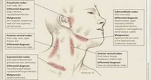 Case of supraclavicular lymph node enlargement.