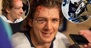Jets’ Morgan Barron shows off gnarly scars from 75 stitches after taking skate to face