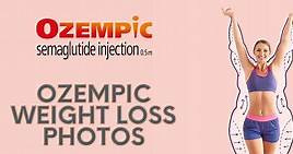 Ozempic Weight Loss Before And After Pictures & Videos - Drug Genius