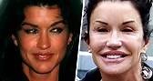 13 Célébrités Avant Et Après La Chirurgie Esthétique