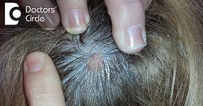 What does small skin colored lump on the scalp indicate? - Dr. Urmila Nischal