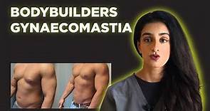 Gynecomastia in bodybuilders - Dr.Hirra Alavi