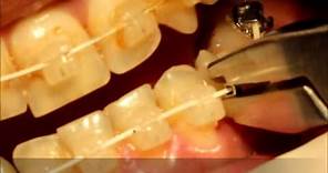 crimpable hook application and class III orthodontic elastics by Dr. Amr Asker