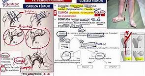 Fracturas: Fémur - Ortopedia y Traumatología (Clases Qx Medic) - 14