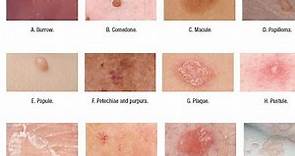 Skin Lesions with defination