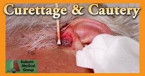 Curettage and Cautery for Basal Cell Carcinoma | Auburn Medical Group