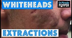 Whitehead extractions on a patient with improving acne