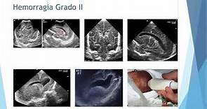 CLASE: Hemorragia de la matriz germinal y lesión hipóxico isquémica neonatal