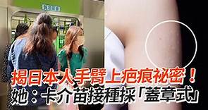揭日本人手臂上疤痕祕密！ 她：卡介苗接種採「蓋章式」
