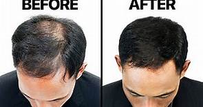 Finasteride (Propecia) For Hair Loss