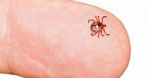 Rocky Mountain Spotted Fever: Symptoms, Treatment, and Prognosis