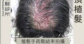頭頂植髮 3109根 # #hairtransplant #植髮手術 #植髮案例 #台灣植髮 #秀冠植髮診所