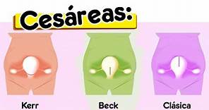 Cuales son los tipos de cesareas / Kerr, Beck y Clasica