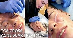 TCA Cross / Acne Scar Treatment Beverly Hills, CA / Darker Skin / Los Angeles