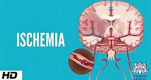 Ischemia, Causes, Signs and Symptoms, Diagnosis and Treatment.