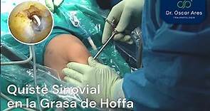 Quiste sinovial en la grasa de Hoffa - Dr. Oscar Ares