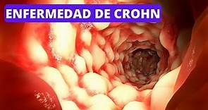 La enfermedad de Crohn explicada: síntomas, causas, tratamientos