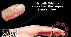Herpetic Whitlow - Everything You Need To Know - Dr. Nabil Ebraheim