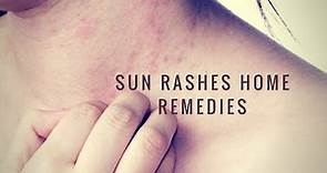 Home remedies for sunburn,sun blisters and rashes