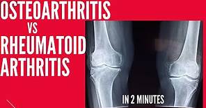 Osteoarthritis vs Rheumatoid arthritis in 2 mins!