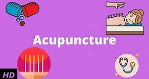Acupuncture: What You Need to Know