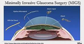 Understanding Glaucoma Diagnosis, Treatment, and Research on the Horizon