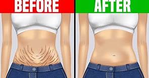 How to Get Rid of Stretch Marks Fast & Naturally