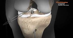 ULTRABUTTON* Device and BIOSURE* REGENESORB Screw for ACL Reconstruction with a Hamstring Graft