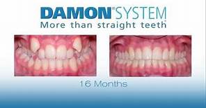 Damon System braces