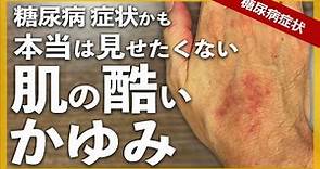 【糖尿病 症状】糖尿病が原因で肌トラブル 身体中の痒み（かゆみ）が止まりません / 皮膚の掻き傷跡が消えません😢