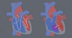 Congenital Heart Defects - What is a CHD?