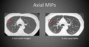 Imaging Lung cancer screening